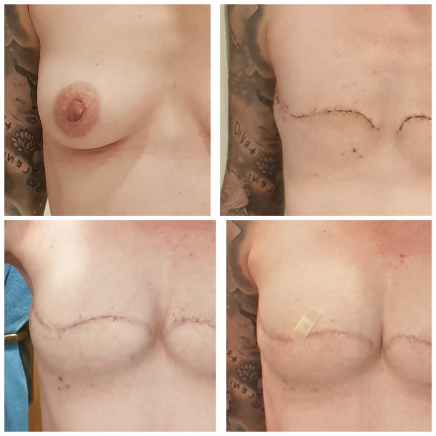 Before and after double mastectomy