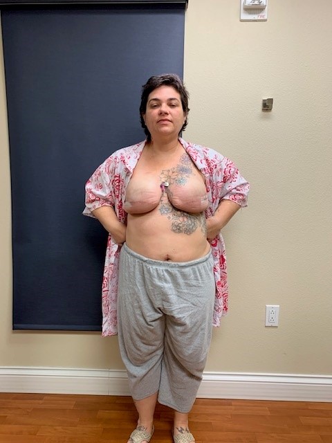 After mastectomy implant exchange surgery, post op 1 day