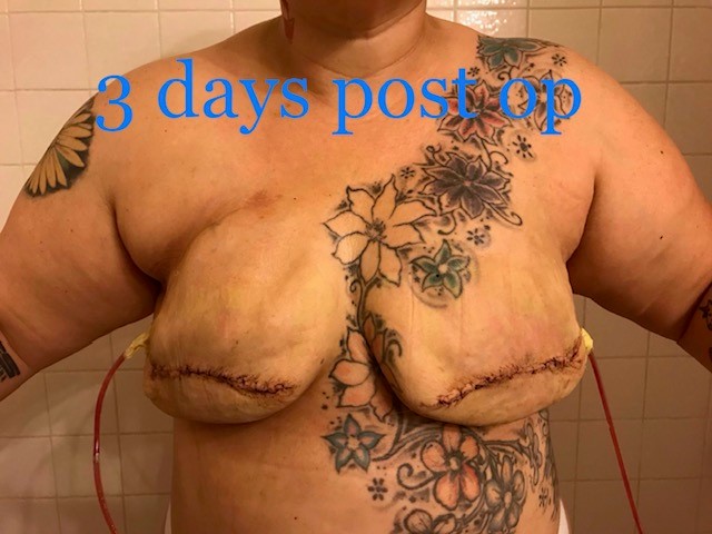 3 days post mastectomy with expanders