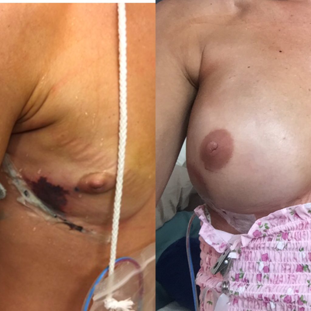 Necrosis after Mastectomy surgery