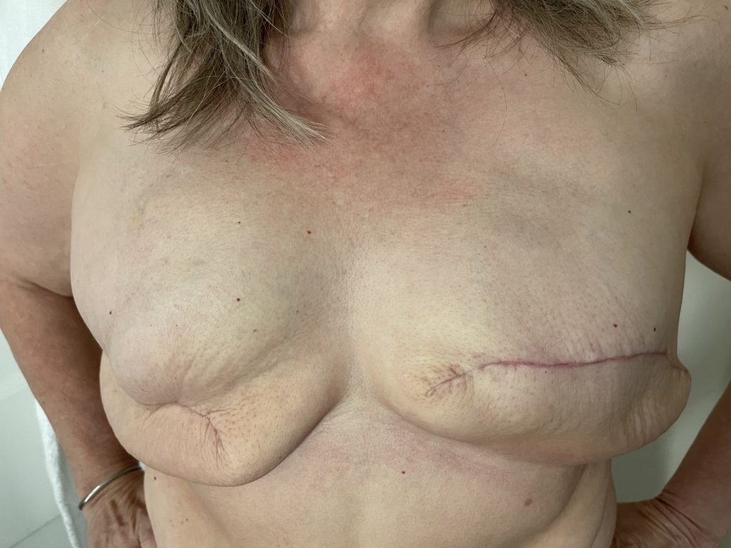 Painful mastectomy scars