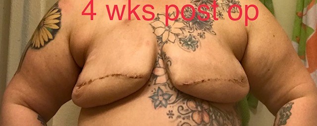 4 weeks post mastectomy