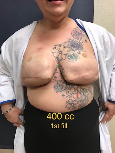 400cc post mastectomy
