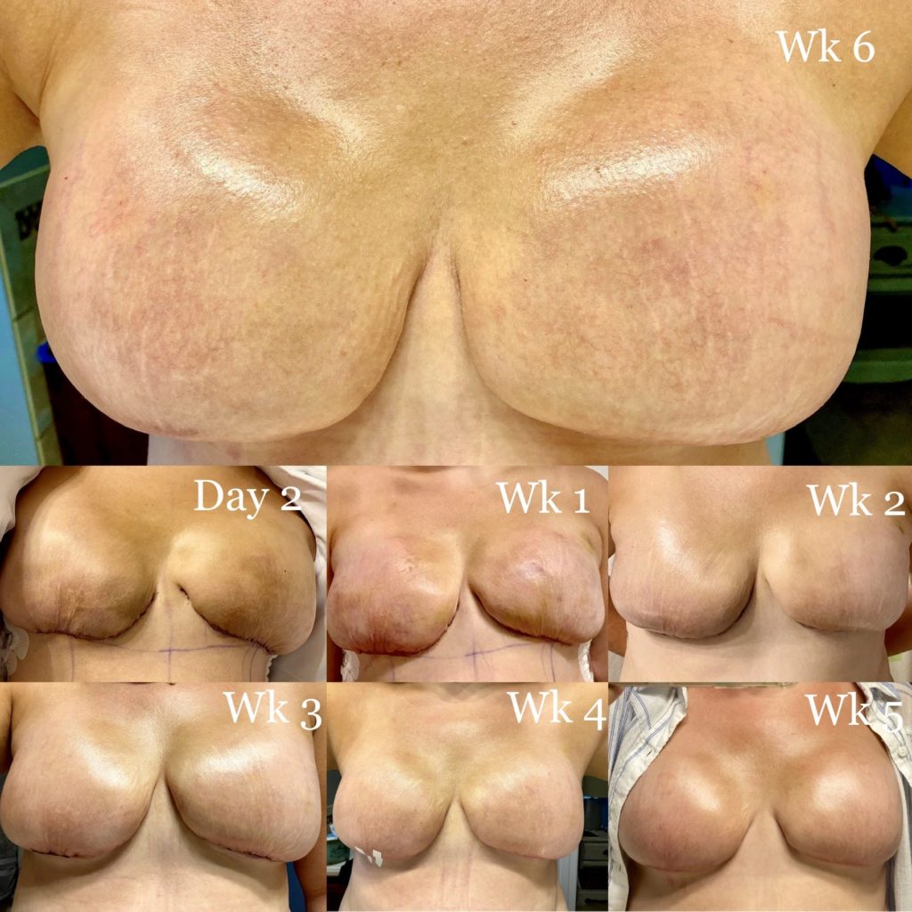 Mastectomy healing collage 6 weeks