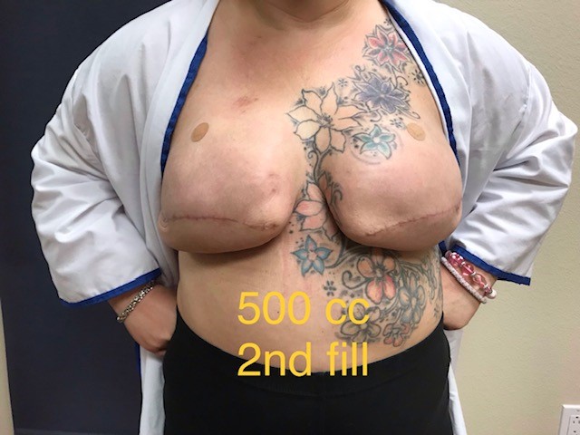 500 cc post mastectomy implants