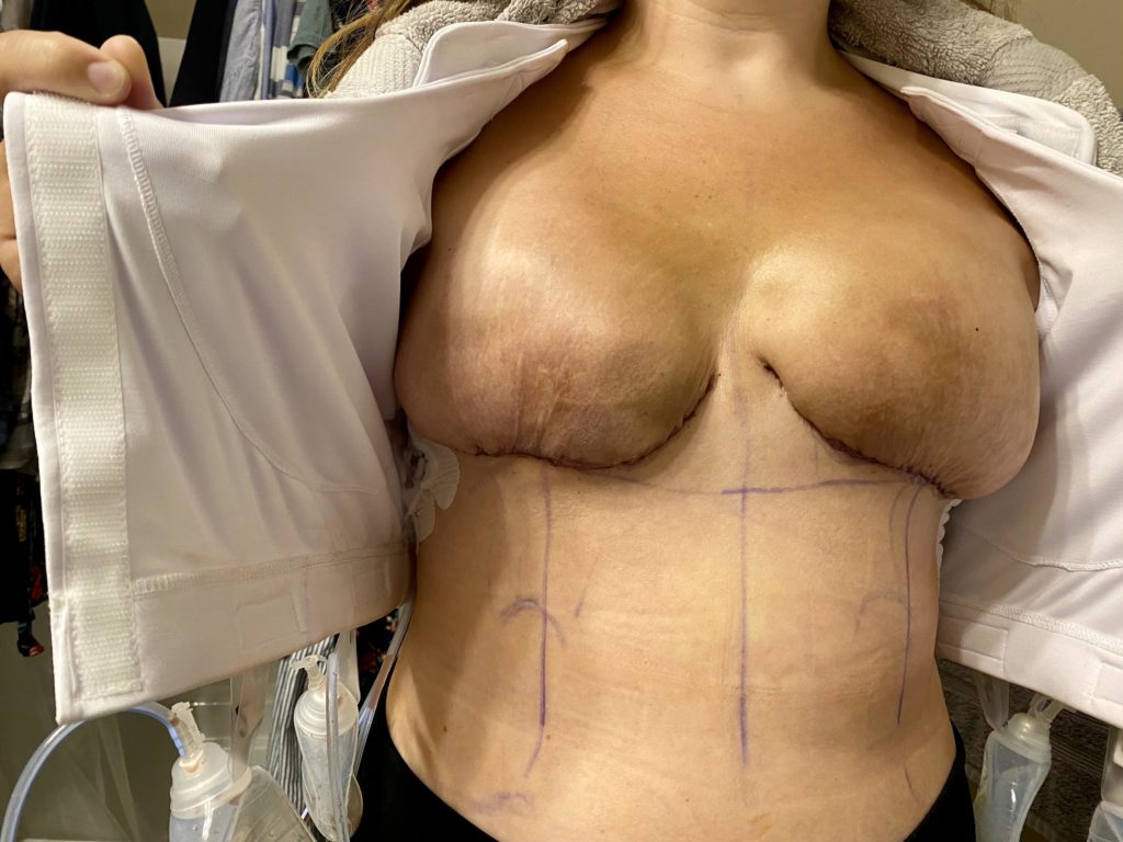 3 Days after expanders after double mastectomy