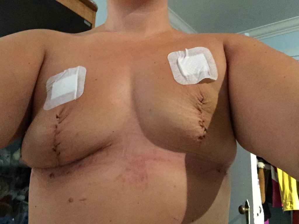 Double Mastectomy after expanders