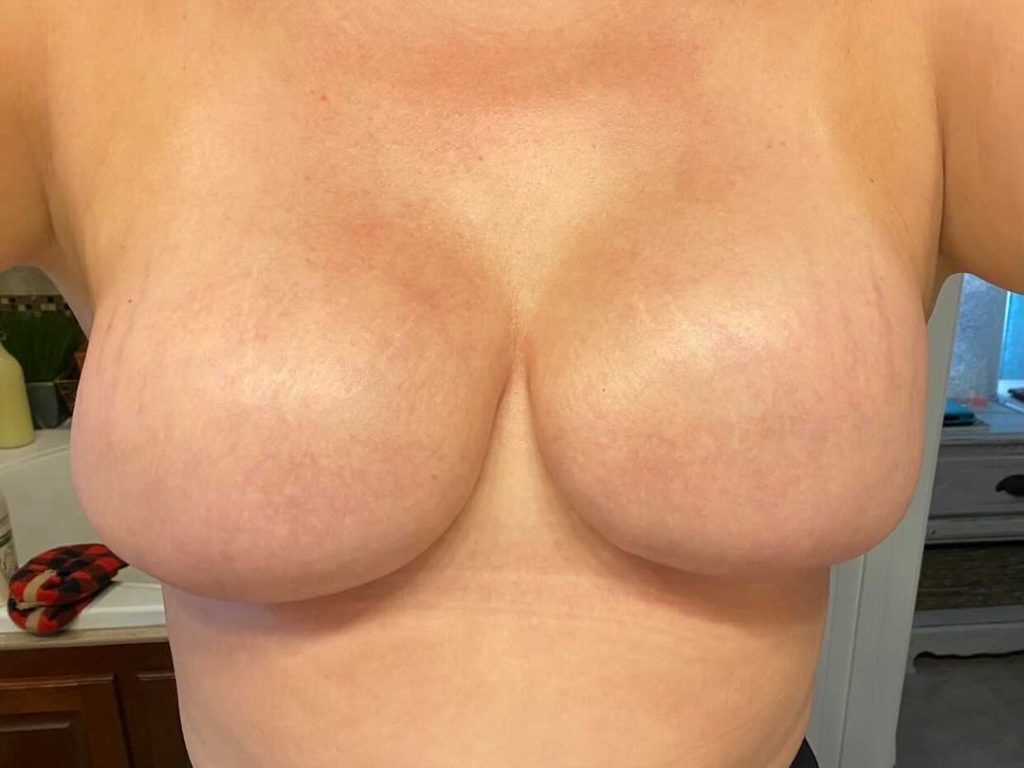 Breast after mastectomy healing