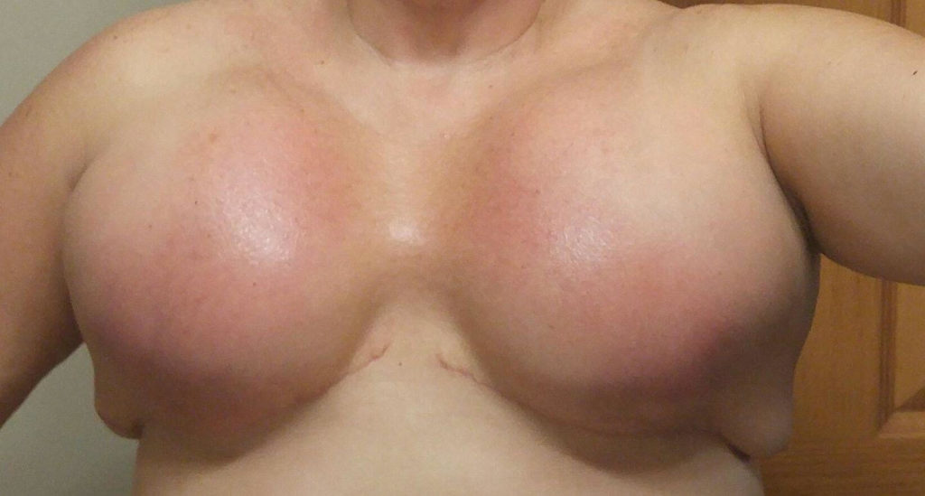 Bilateral mastectomy with expanders