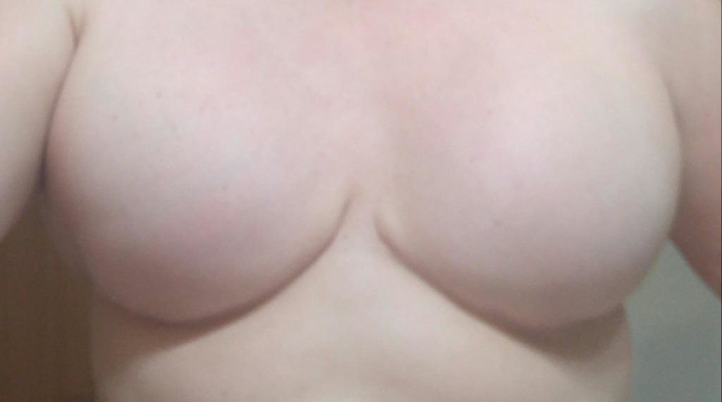Breast after nipple removal no scars