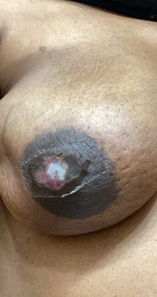 Nipple at breast cancer diagnosis