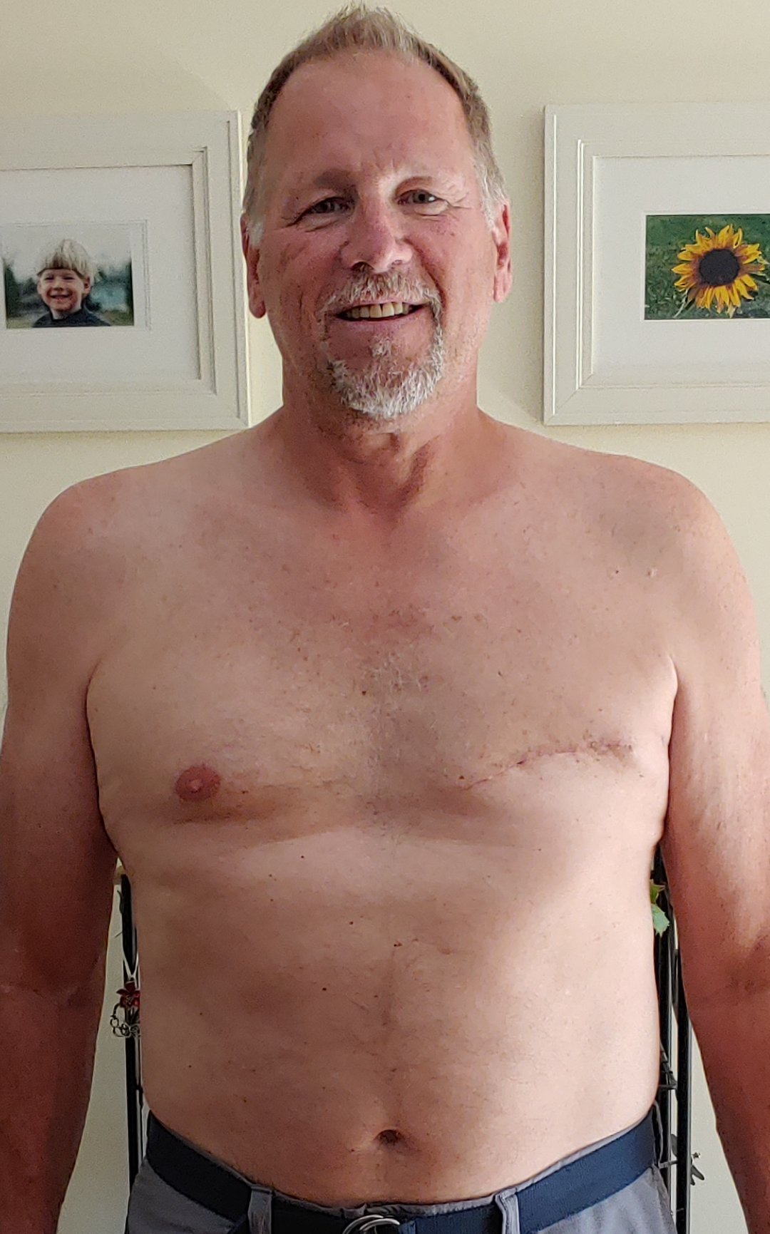 Male after mastectomy