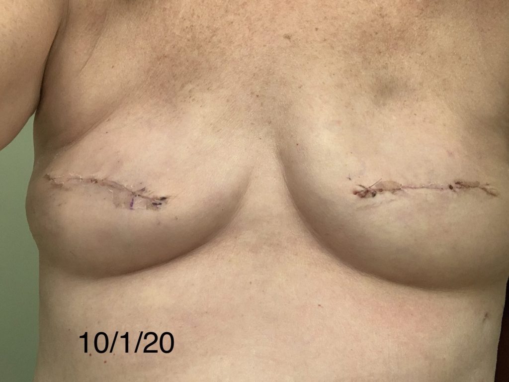 1 week post op double mastectomy to expanders front view