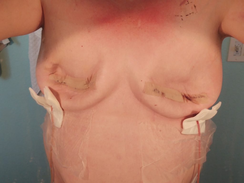 Bilateral mastectomy and axillary lymph node dissection