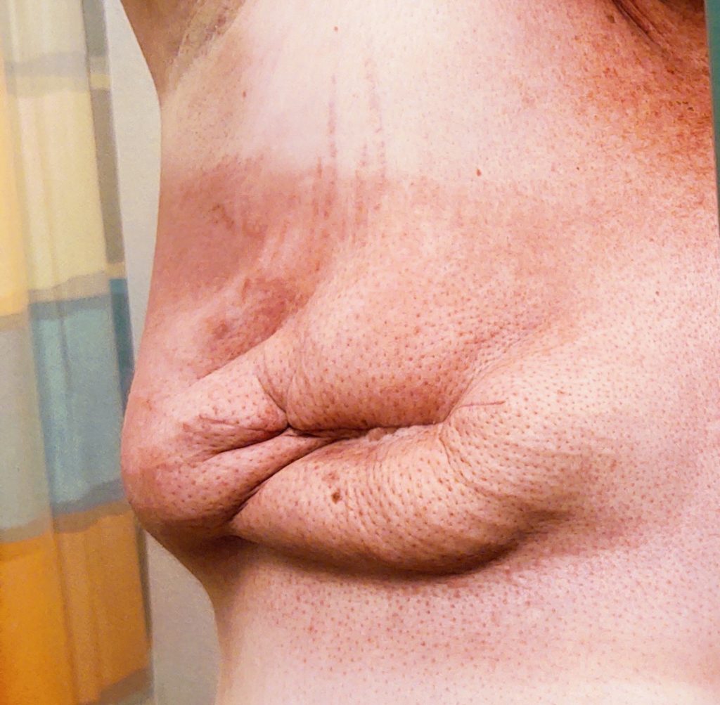 Concave breast after mastectomy
