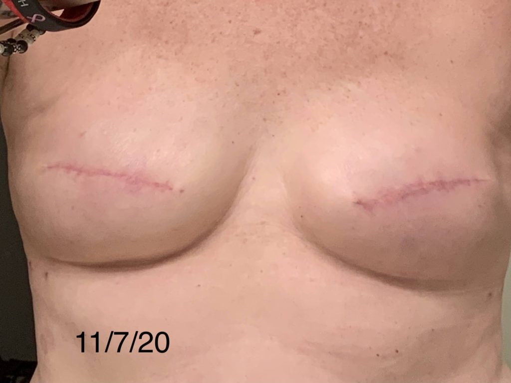 8 weeks post op double mastectomy to expanders