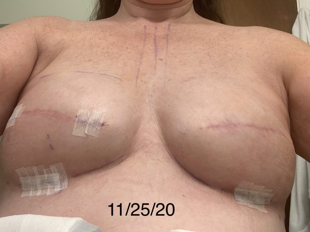 2 days post op exchange Mastectomy surgery to implants