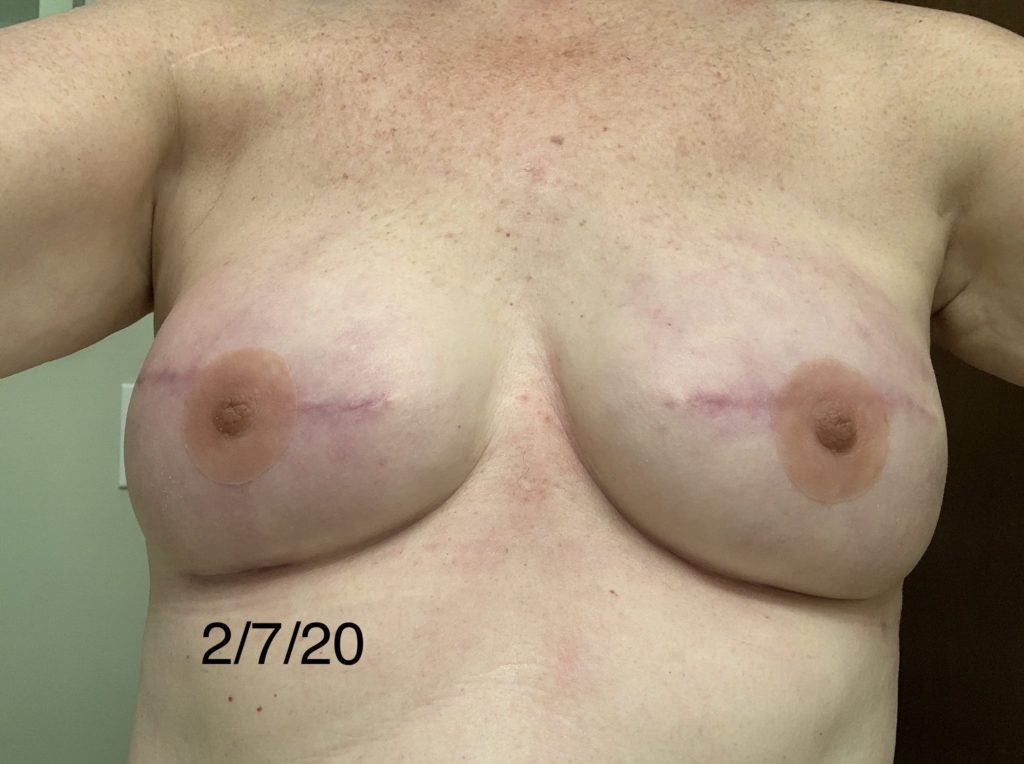 2 1/2 months post op exchange w/ pink perfect nipples (prosthetic nipple brand)