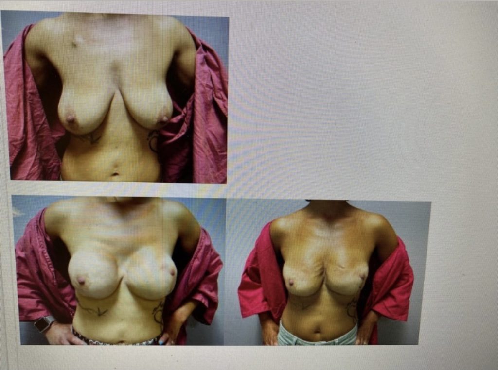 Before and after nipple revision surgery