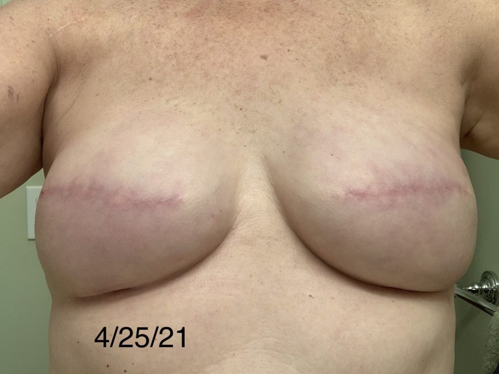 5 months post op exchange Mastectomy