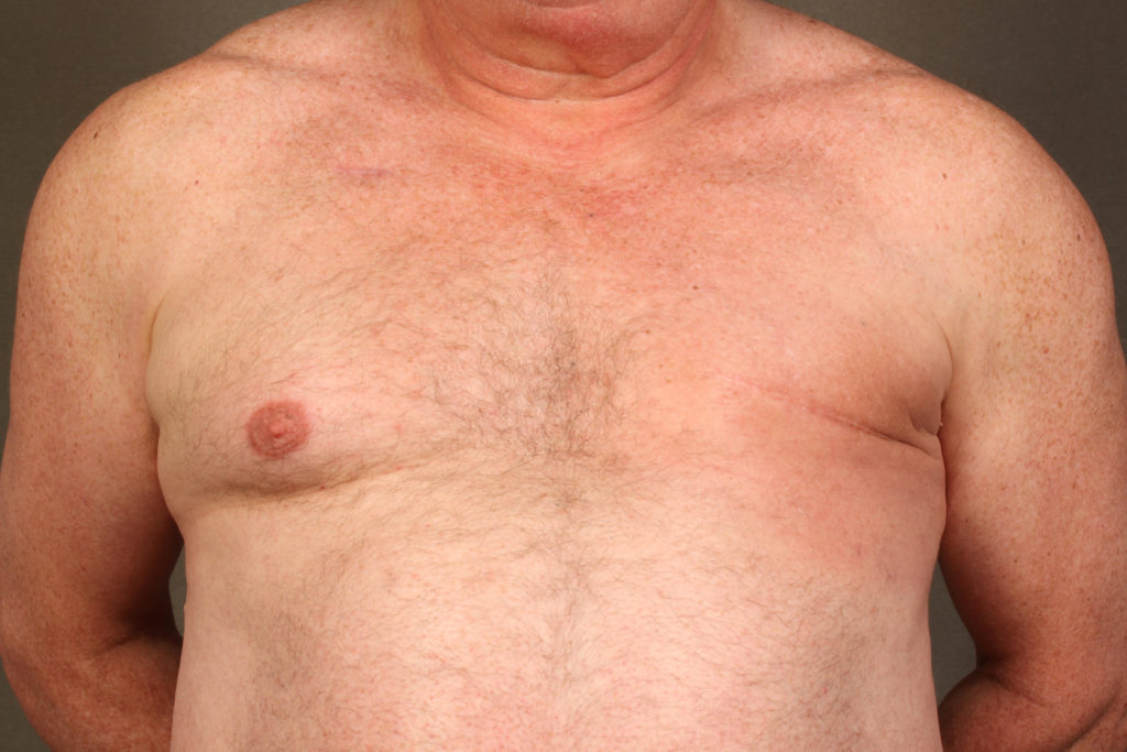 Man after Breast cancer surgery