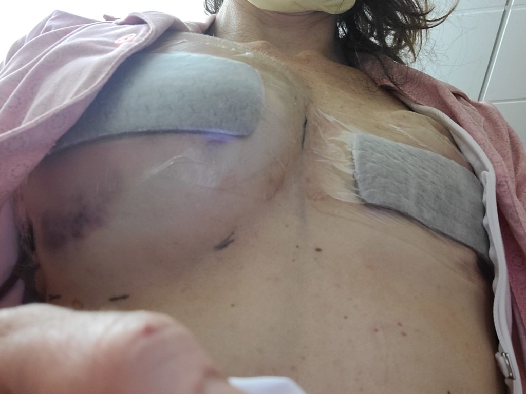 After my mastectomy breast reconstruction