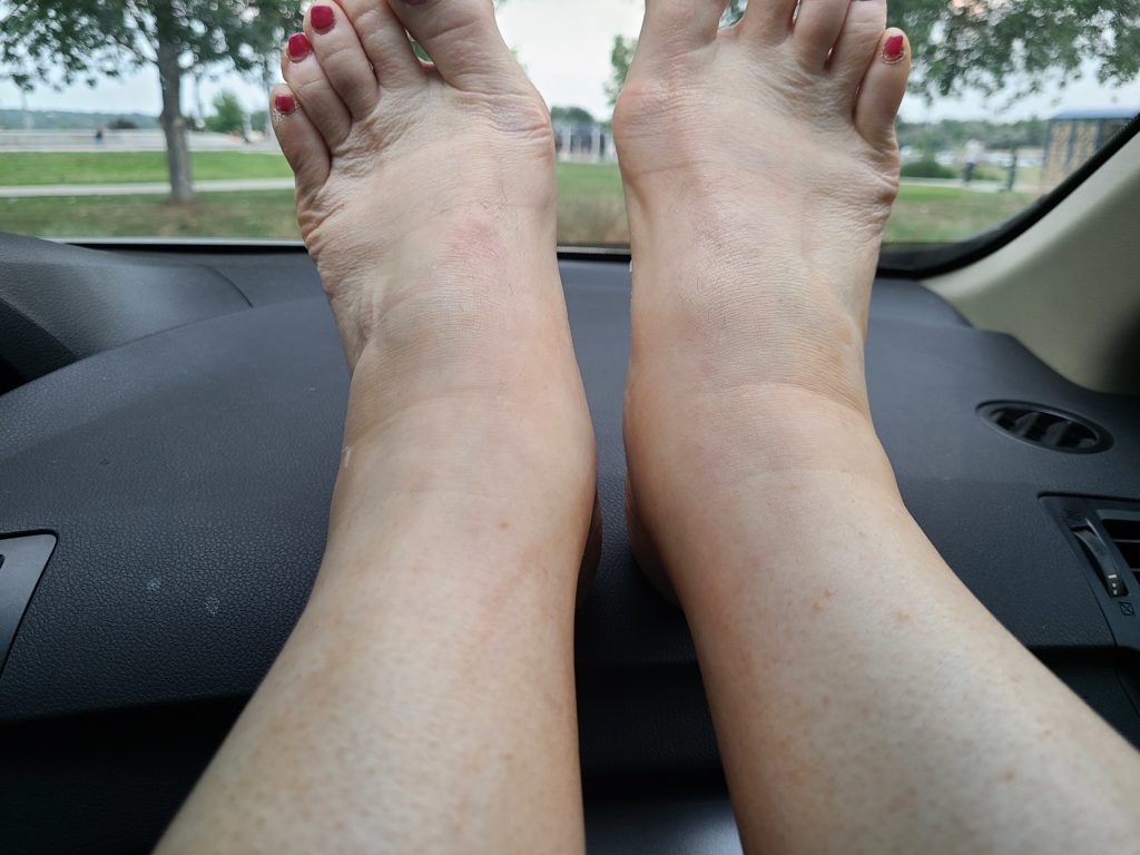 Swollen ankles (edema) after mastectomy surgery