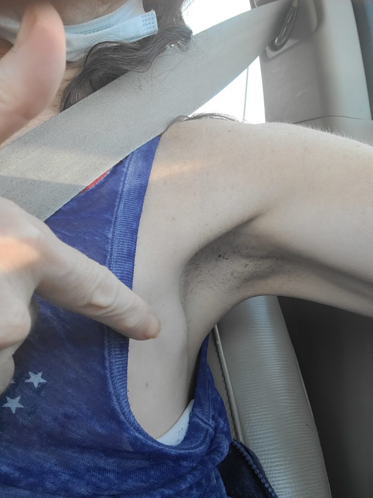 Swollen node near armpit after mastectomy