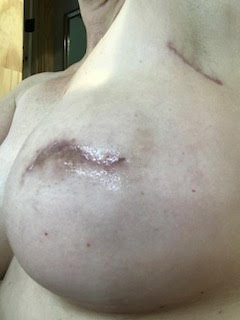 bilateral nipple sparing after revision