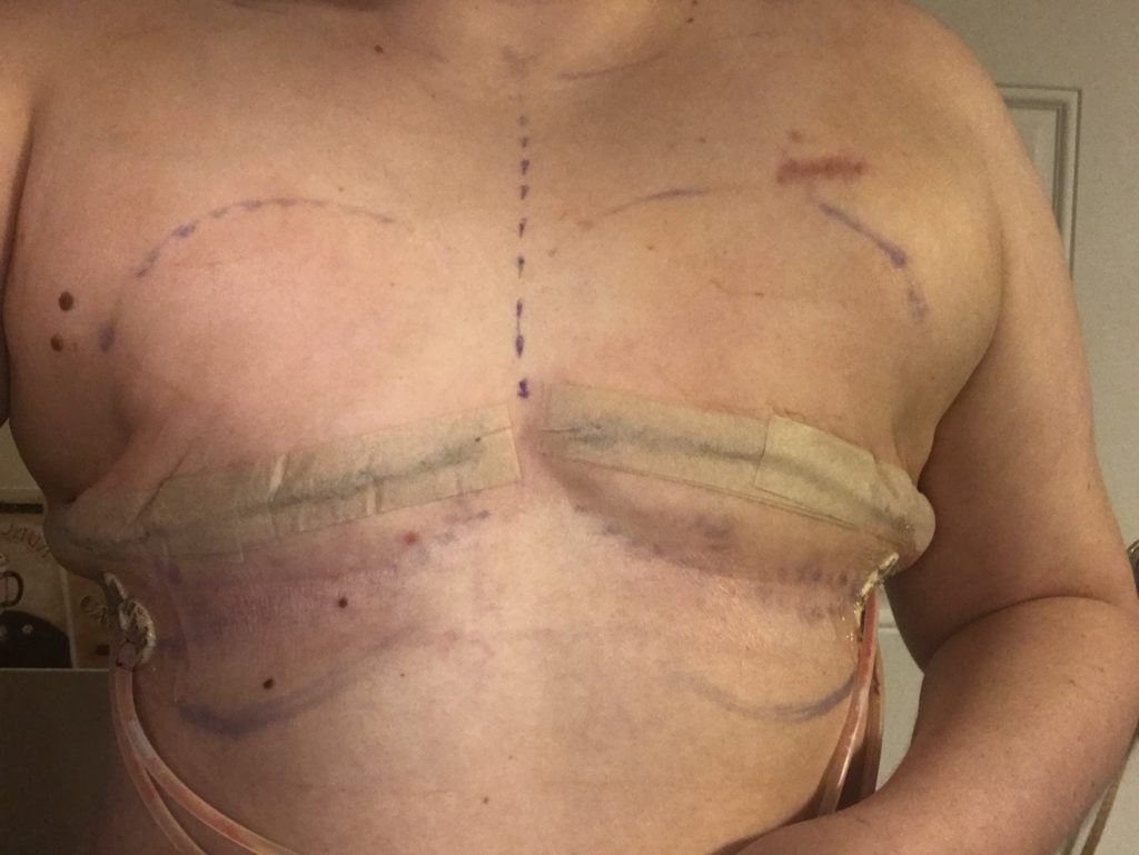 Double mastectomy scars with tissue expanders