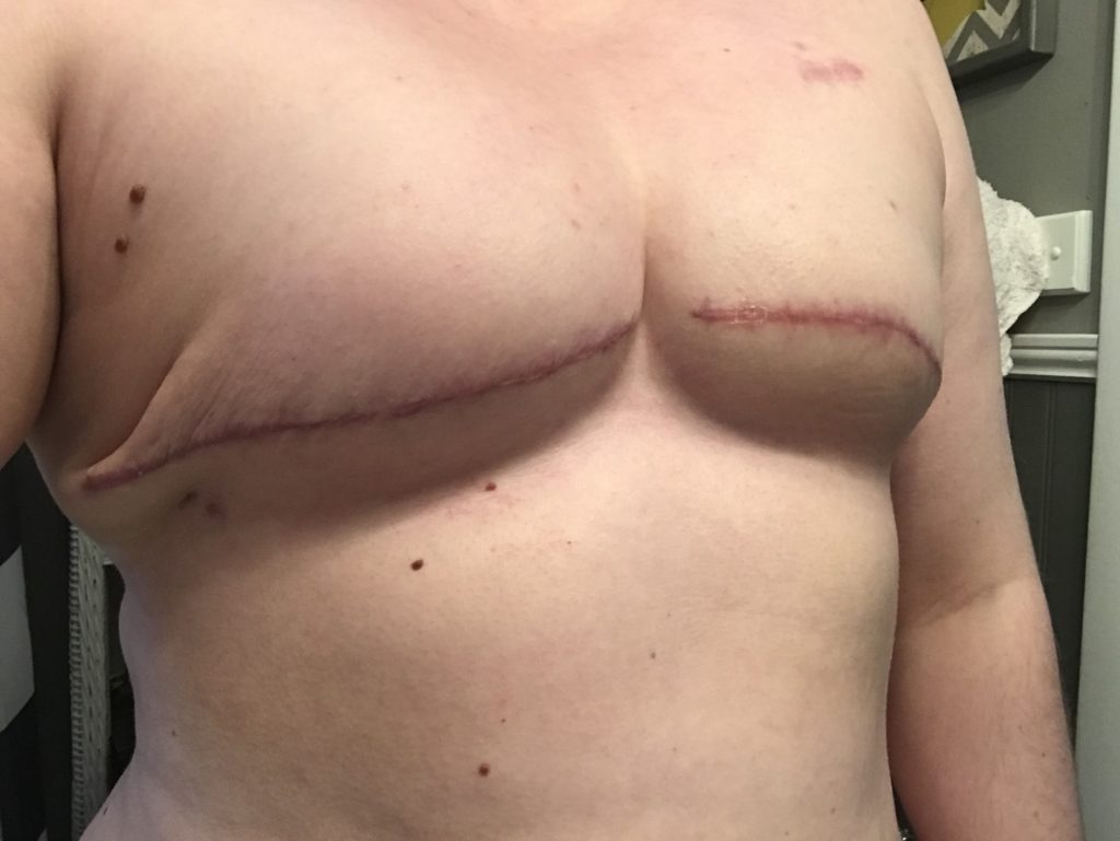 Mastectomy scar after expanders are filled more