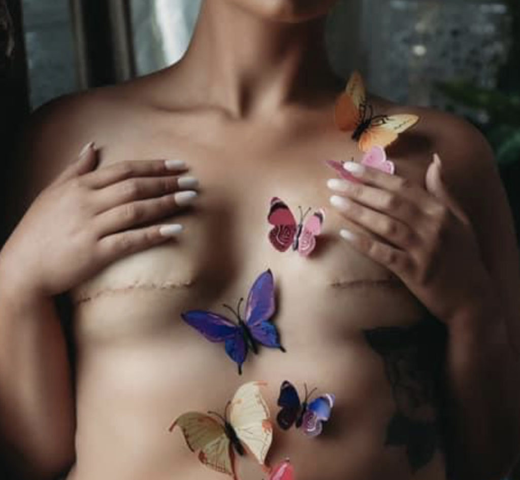 Mastectomy scars with butterflies