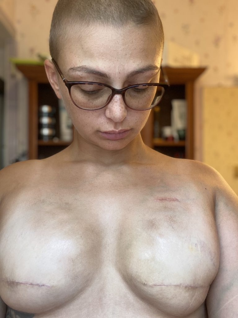 Short haired girl with glasses mastectomy