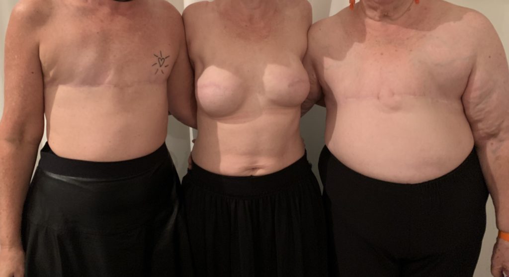 Going flat after a mastectomy