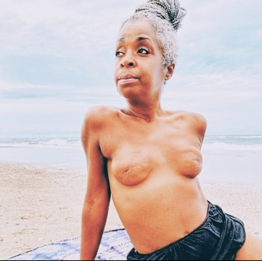 Topless Beach Mastectomy