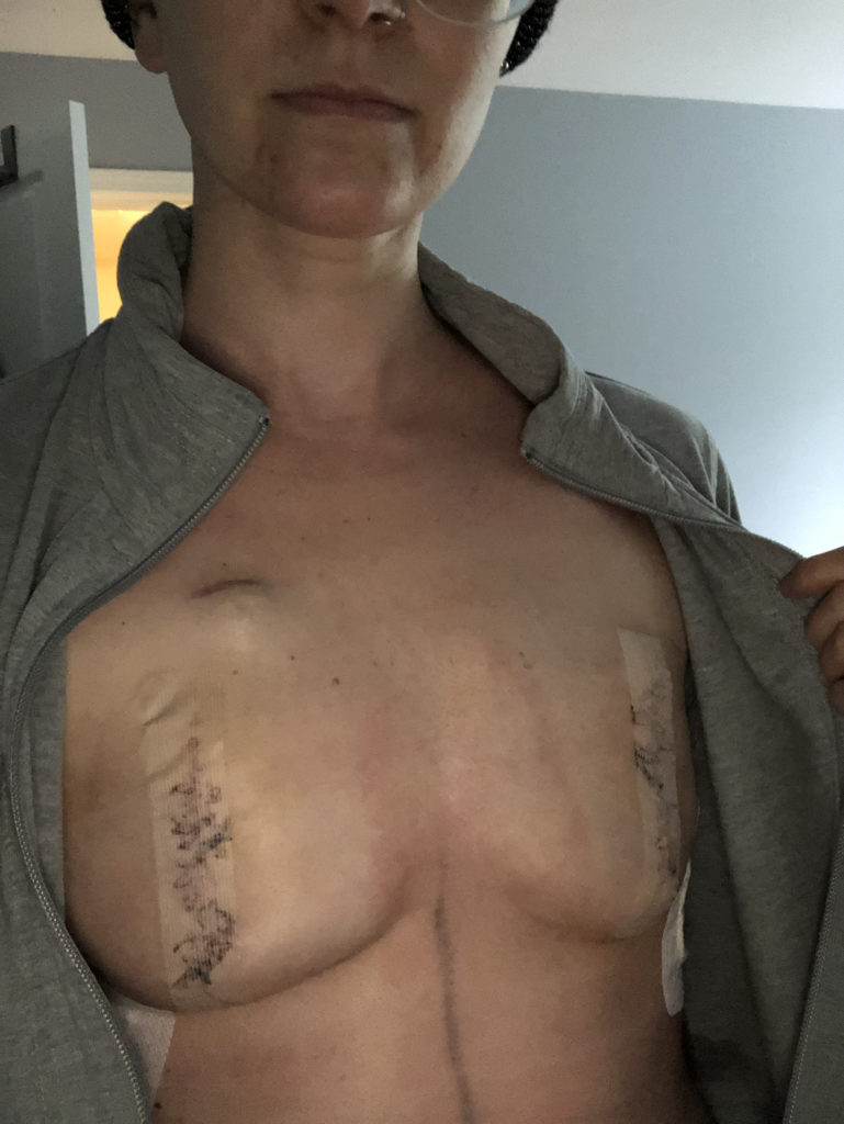 Skin sparing double mastectomy with tissue expanders