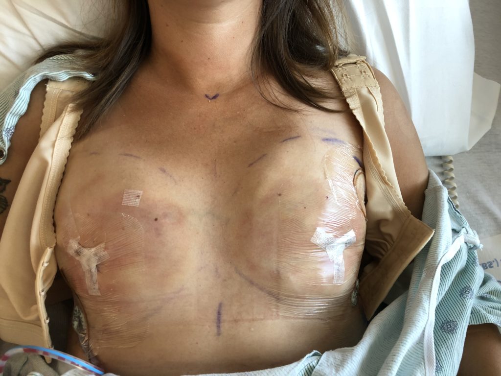 Double skin sparing mastectomy