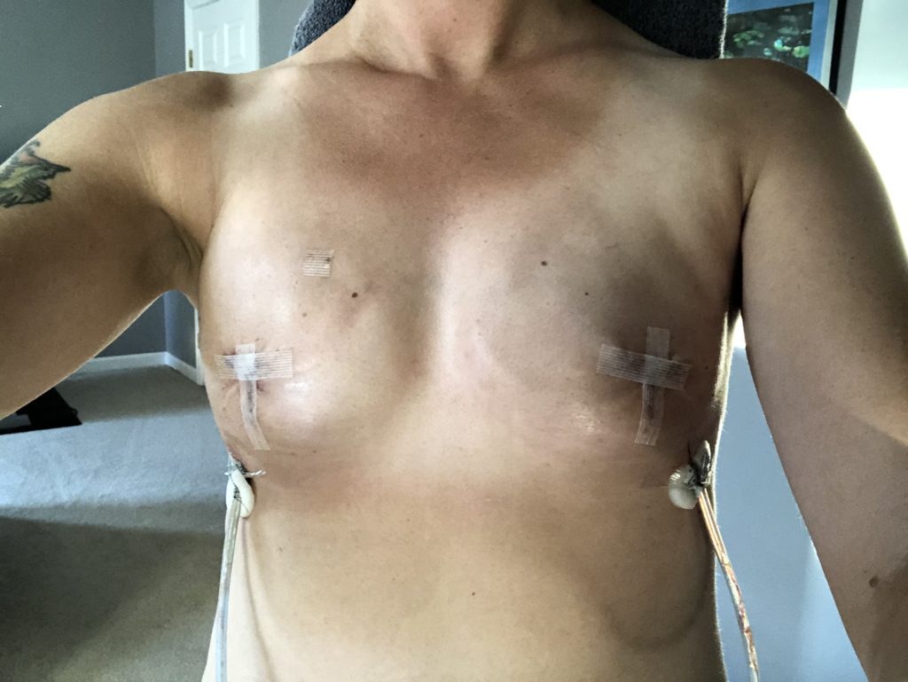 mastectomy tissue expanders and "JP" drains
