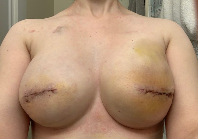 After exchange surgery from tissue expanders to implants