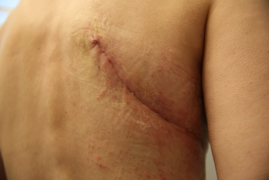 Mastectomy scars from infection