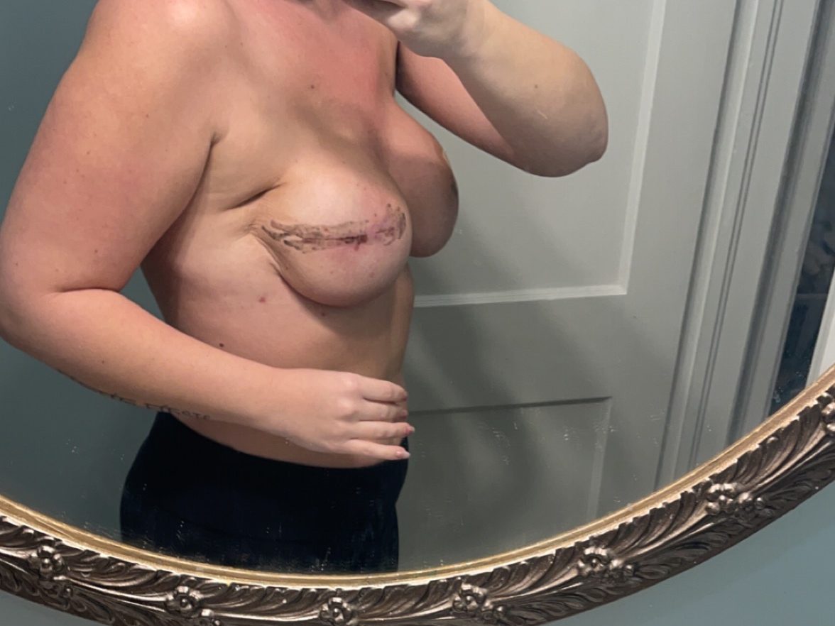 Fever and body aches after mastectomy surgery