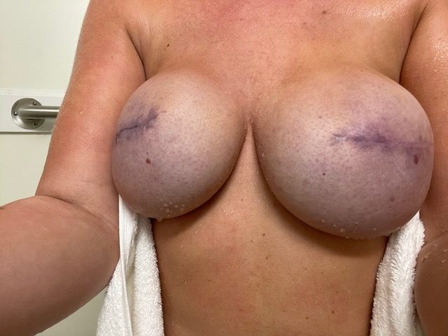 Blue Bruising after breast surgery