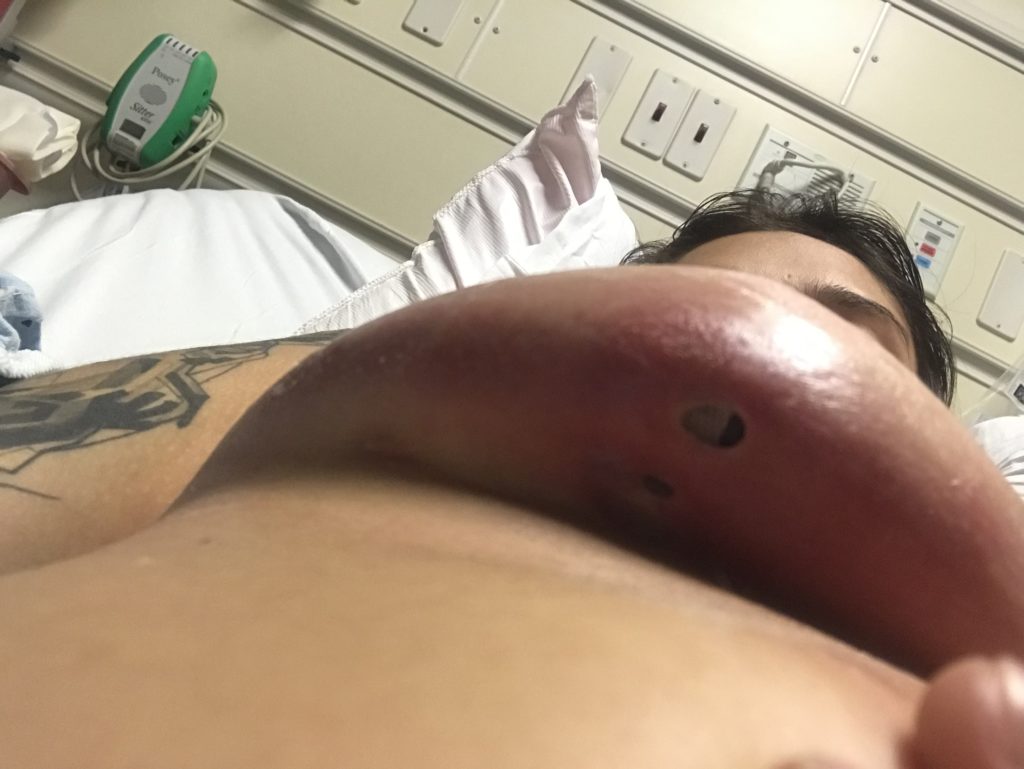 Mastectomy infection under breast