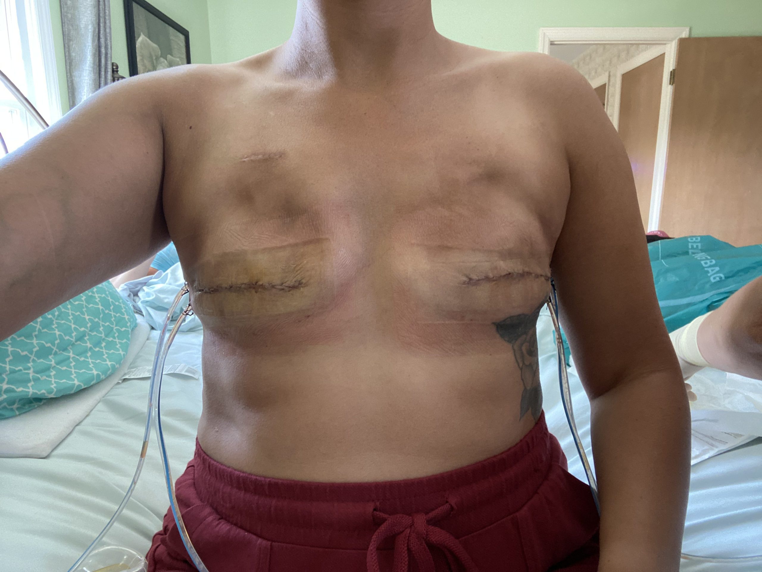 Double mastectomy, skin sparing, expanders placed