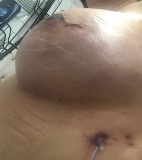Bilateral nipple sparing mastectomy