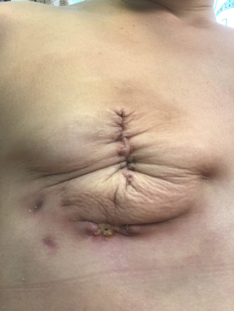 Mastectomy after pregnancy 