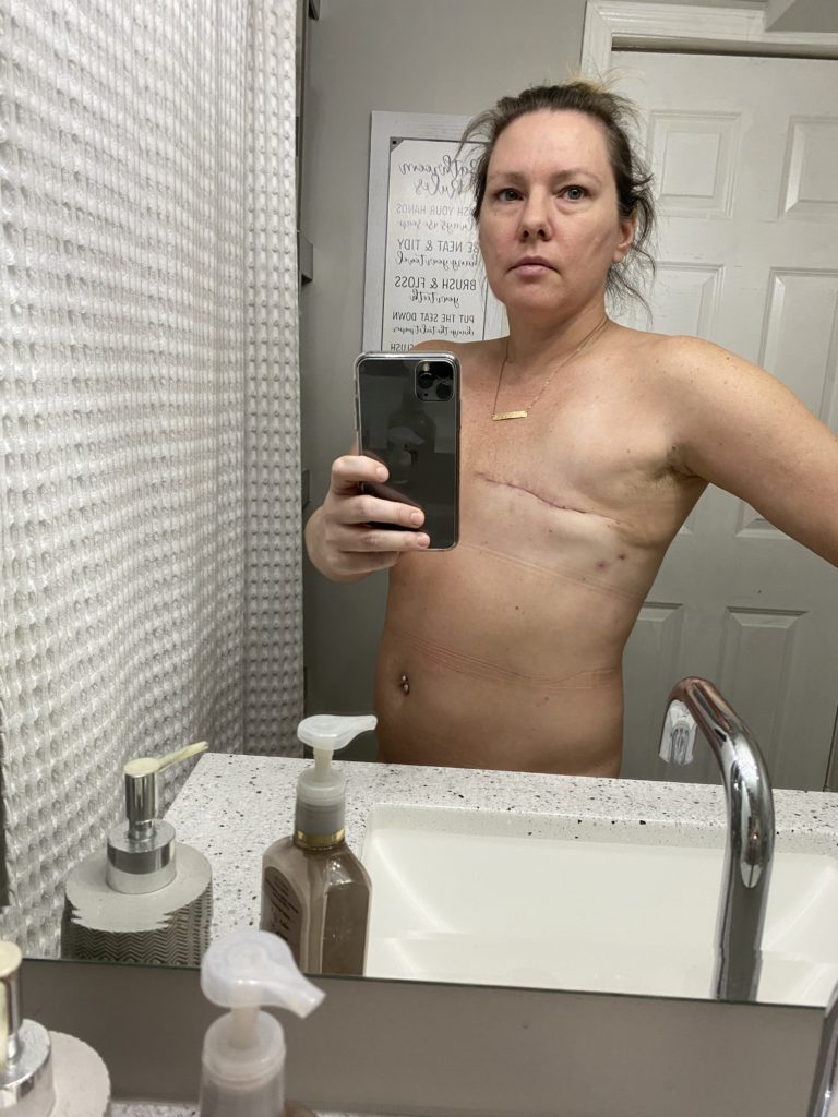 Aesthetic Flat Closure, single 10.0 - Empowered Mastectomy